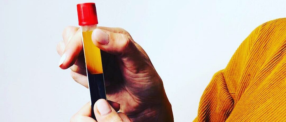 The Vampire Facial in which blood is drawn from your arm, just like a blood test, and then inserted into the gold-plated needle system along with hyaluronic acid. 