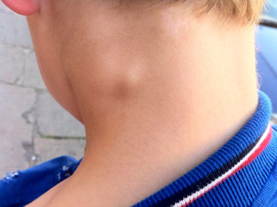 Ganglion Kisti Nedir