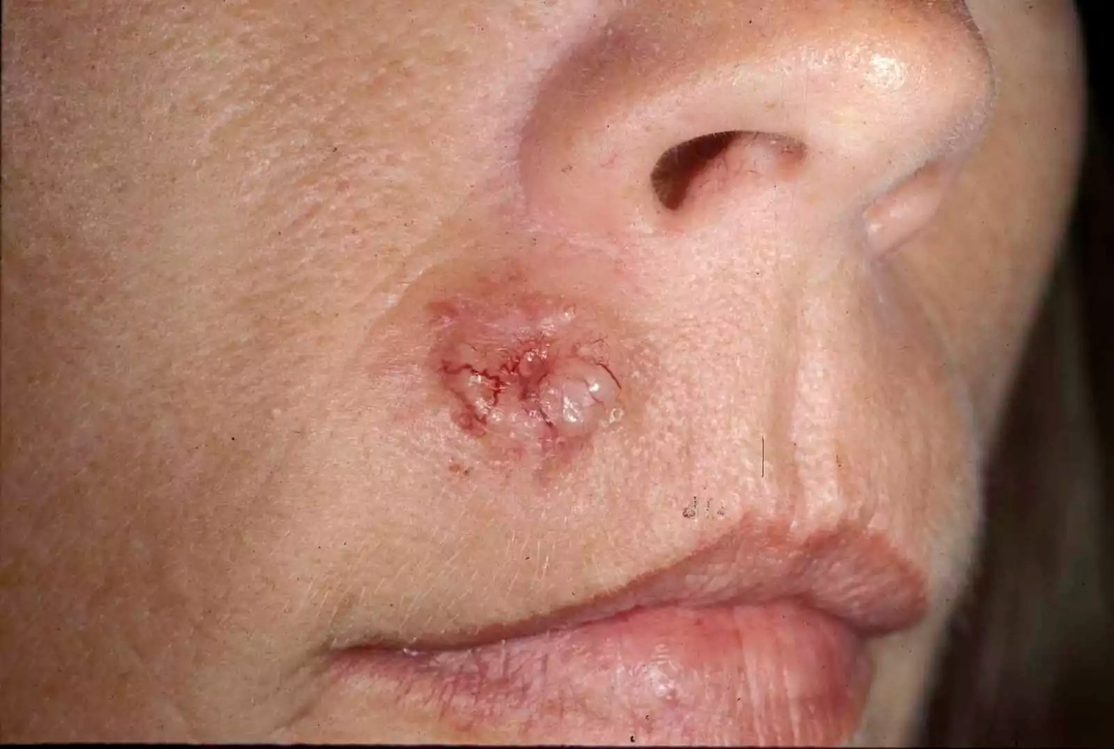 Basal Cell Carcinoma on the face