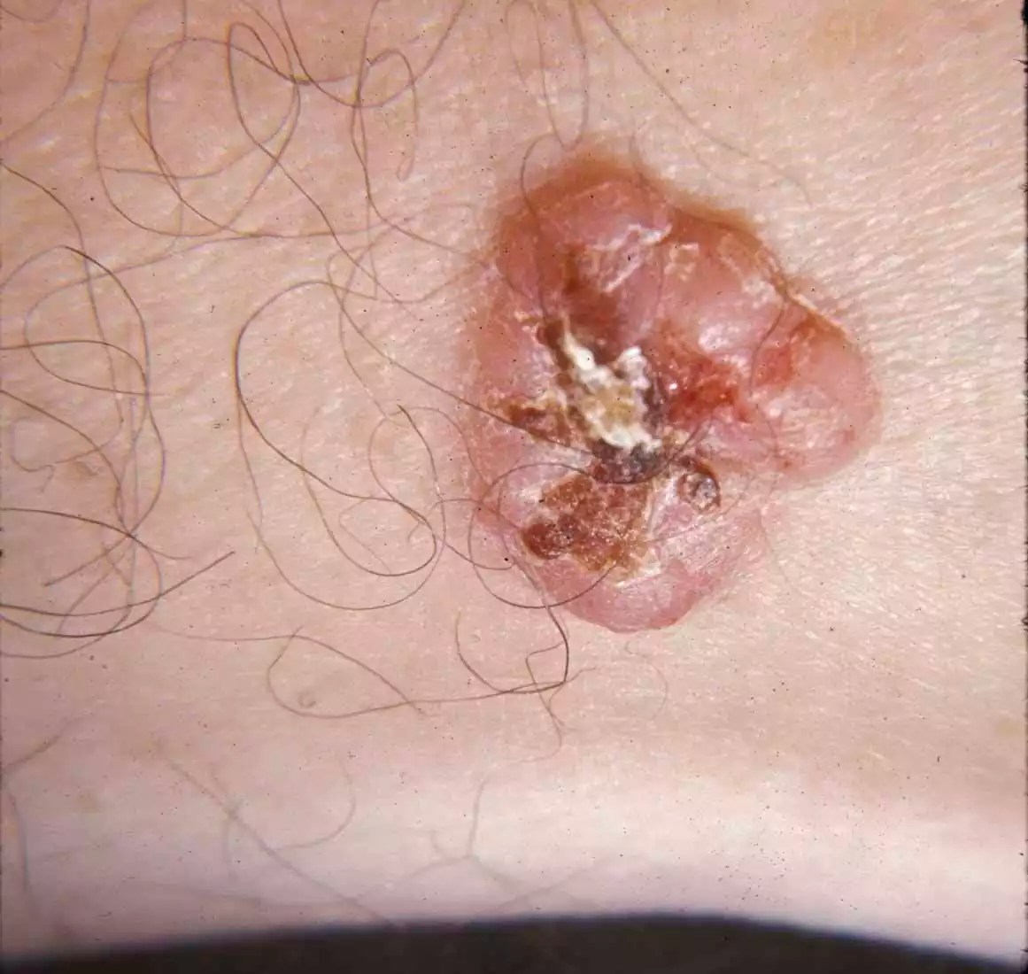 Basal Cell Carcinoma Example.