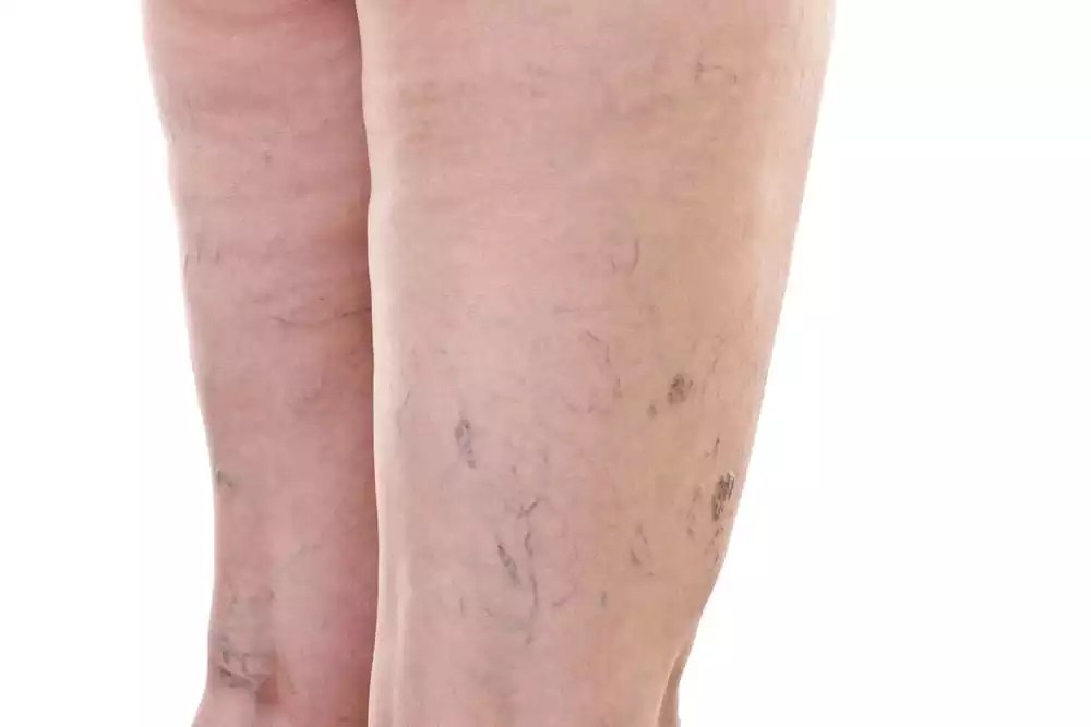 Broken Blood Vessels Example
