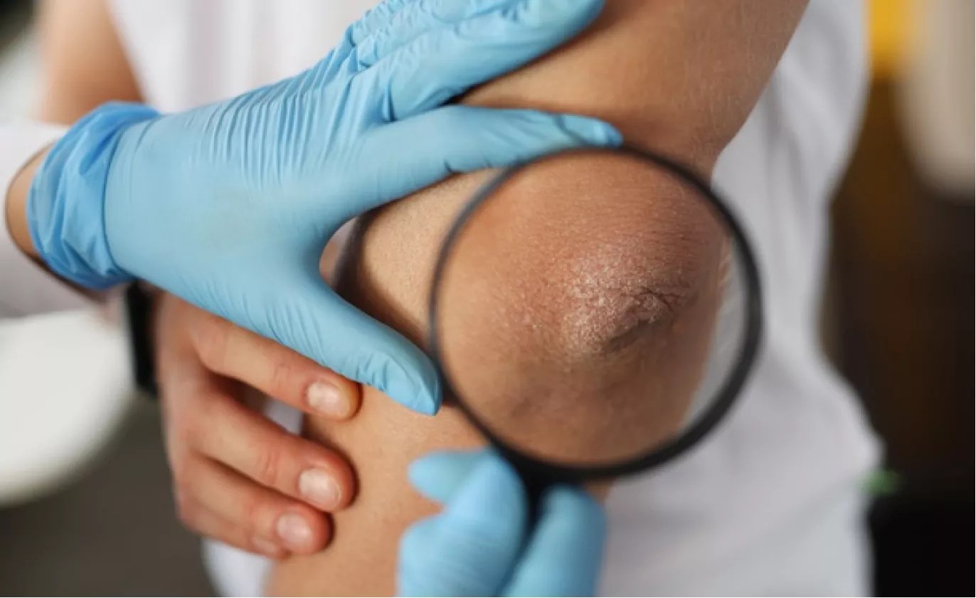 Psoriasis treatment