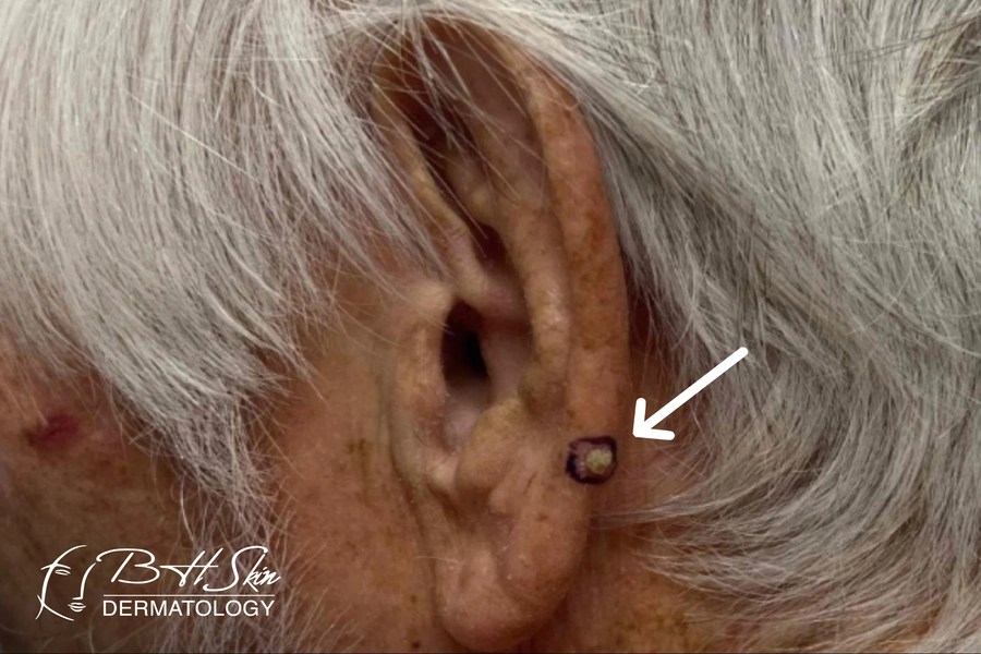 An elderly person's ear with gray hair has a dark, raised spot near the earlobe indicated by a white arrow. The bottom left corner shows text: 