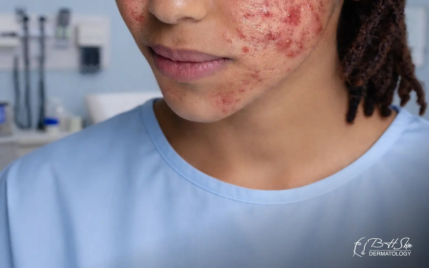 Severe, Persistent Acne