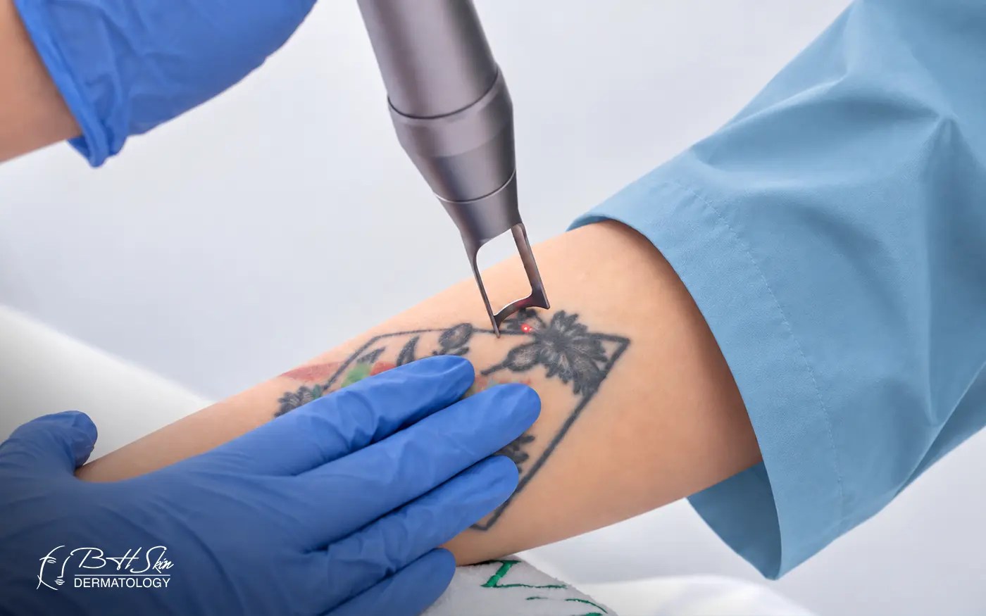 Laser Tattoo Removal