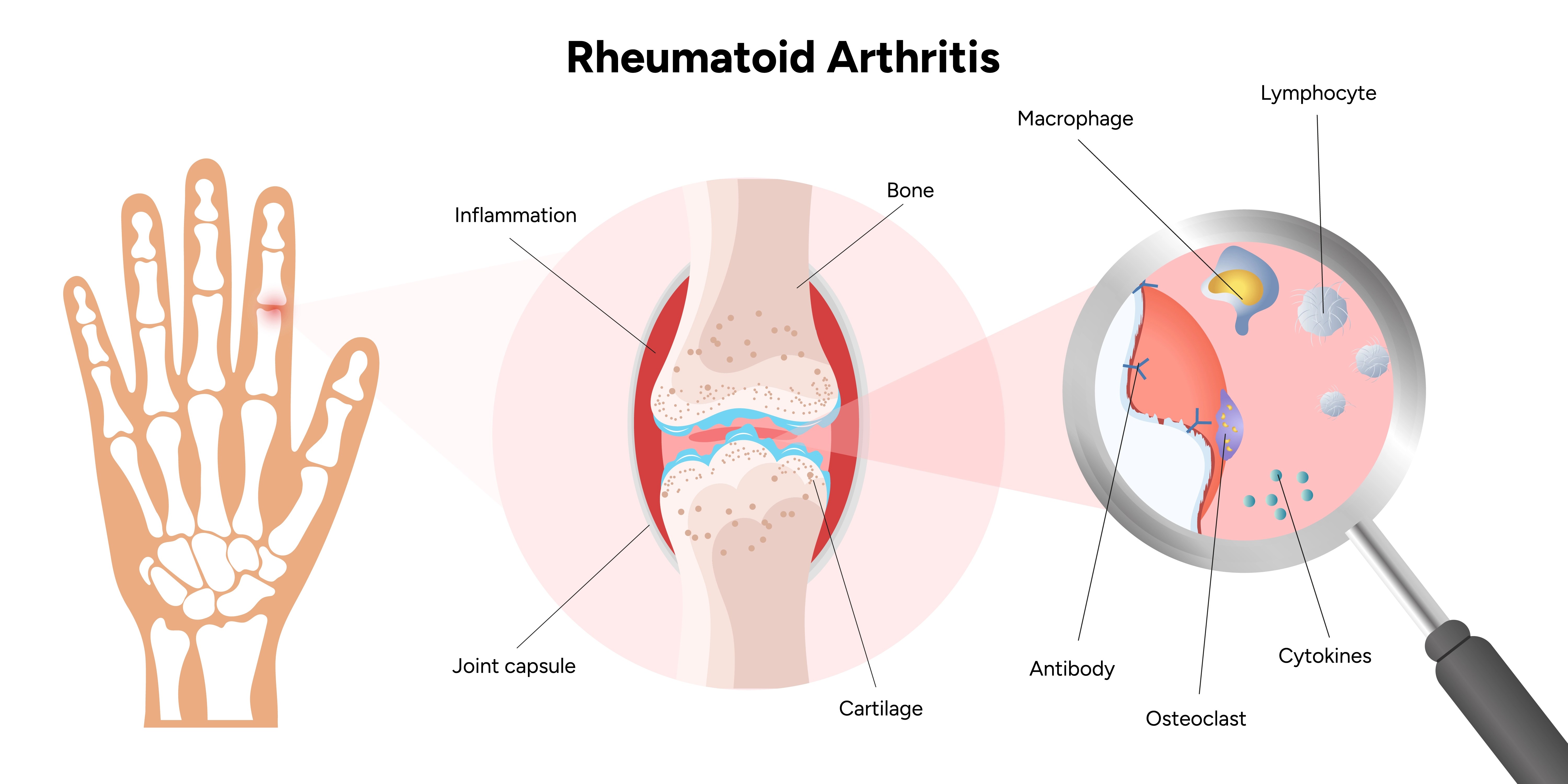 Rheumatoid Arthritis