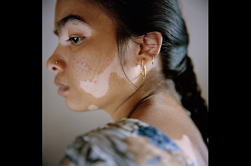 Kaynaklarınıza "MedPulse" ekleyin veya. Vitiligo: Kraliyet hastalığı Vitiligo tamamen ortadan kaldırılamaz