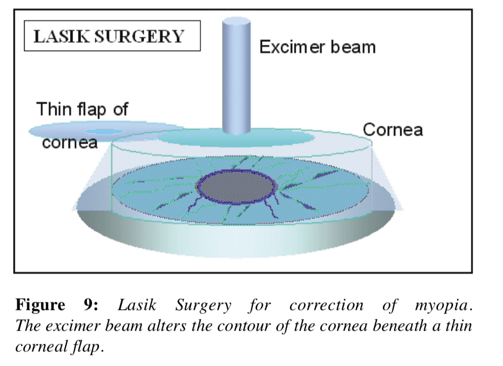 Diagram of LASIK surgery illustrating the science of LASIK, with an excimer beam reshaping the cornea beneath a thin flap to correct myopia.