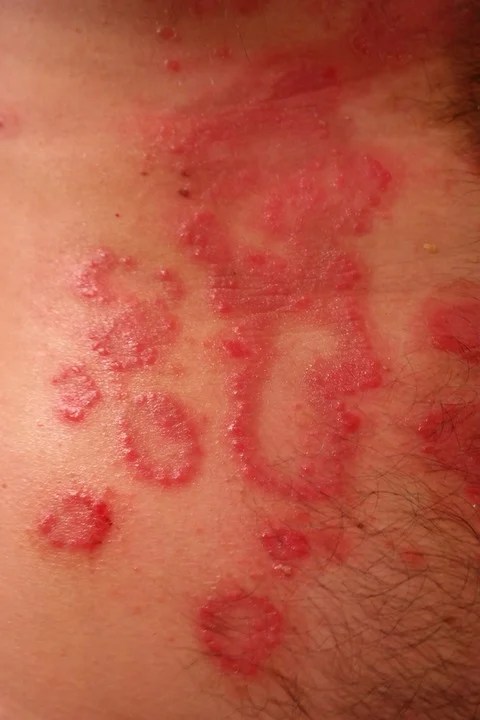 Can shingles develop without chickenpox?