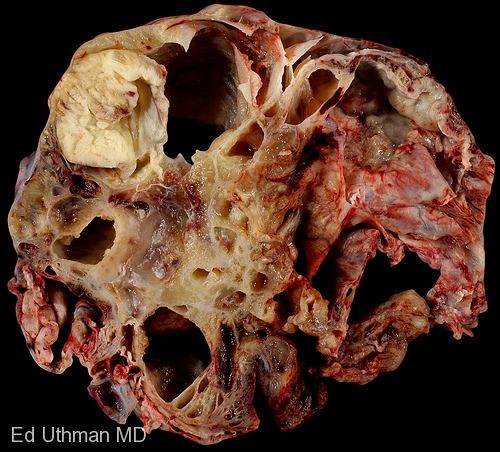 Pleural mesothelioma develops in the pleura, the membrane that covers the lungs. PERITONEAL CANCER SURVIVAL RATE