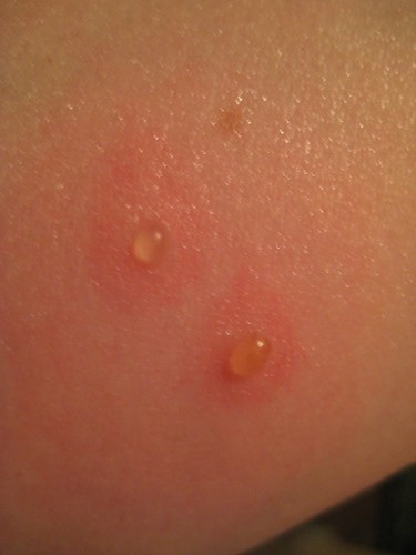 Bed Bug Bites Pictures And Symptoms - Ultra HD Abstract Photos for Desktop