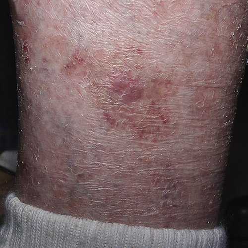 Lyme disease blood test