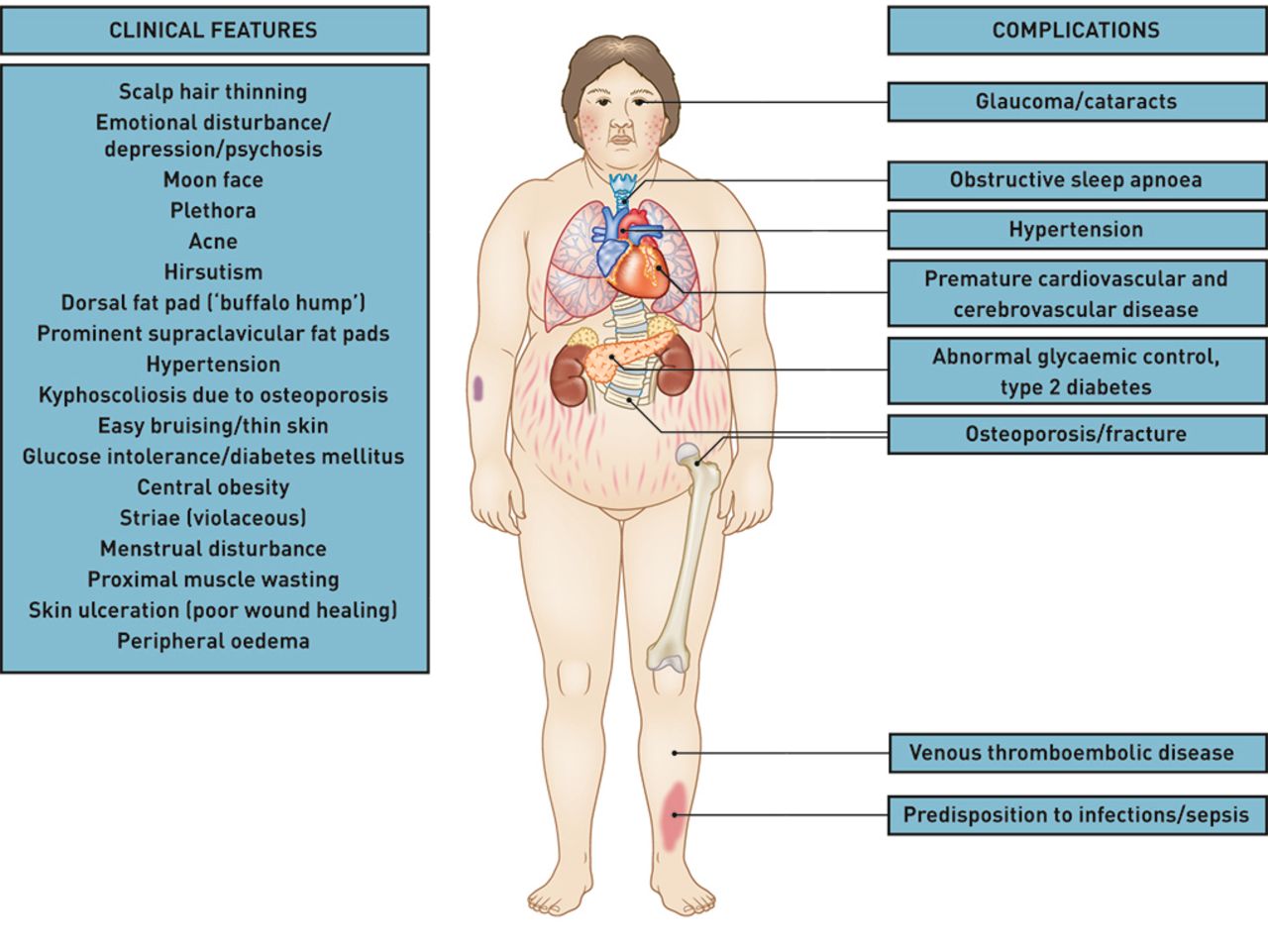 Cushings disease symptoms 💡quick tip💡 cushing's disease signs