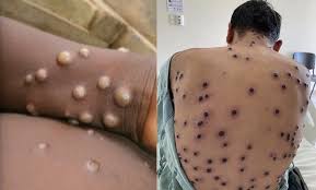 DANIEL WHYTE III, PRESIDENT OF G.L.S. INTERNATIONAL, SAYS THAT THE MONKEYPOX (MPOX) OUTBREAK IS NOT A PLAGUE SENT BY GOD LIKE THE CORONAVIRUS PLAGUE THAT HE STARTED PREDICTING OVER 10 YEARS BEFORE IT HIT