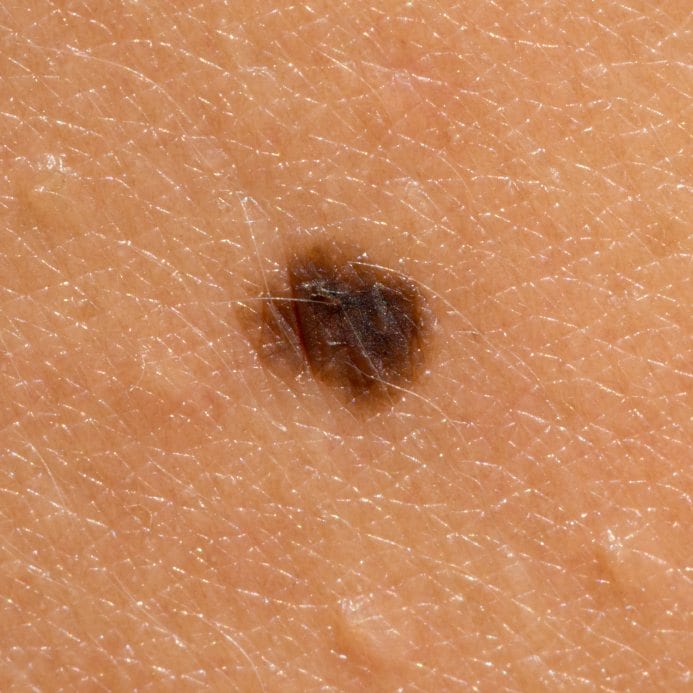 Find facts and statistics for reporting about skin cancer. New Studies On Breast Cancer Risk 23andme Blog