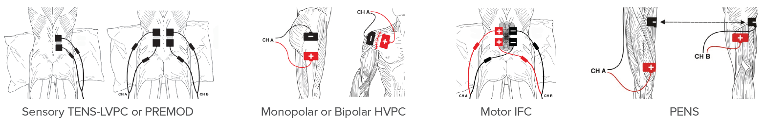 Neuromodulation Ecpc - Gradient Arts - Professional 4K Collection