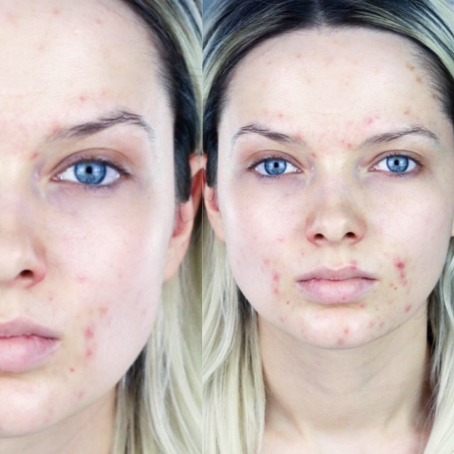 Roaccutan comprare italia