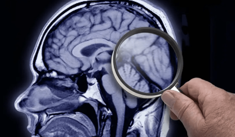 Alzheimer: saiba mais sobre a doença, seus sintomas, como preveni-la e tratá-la