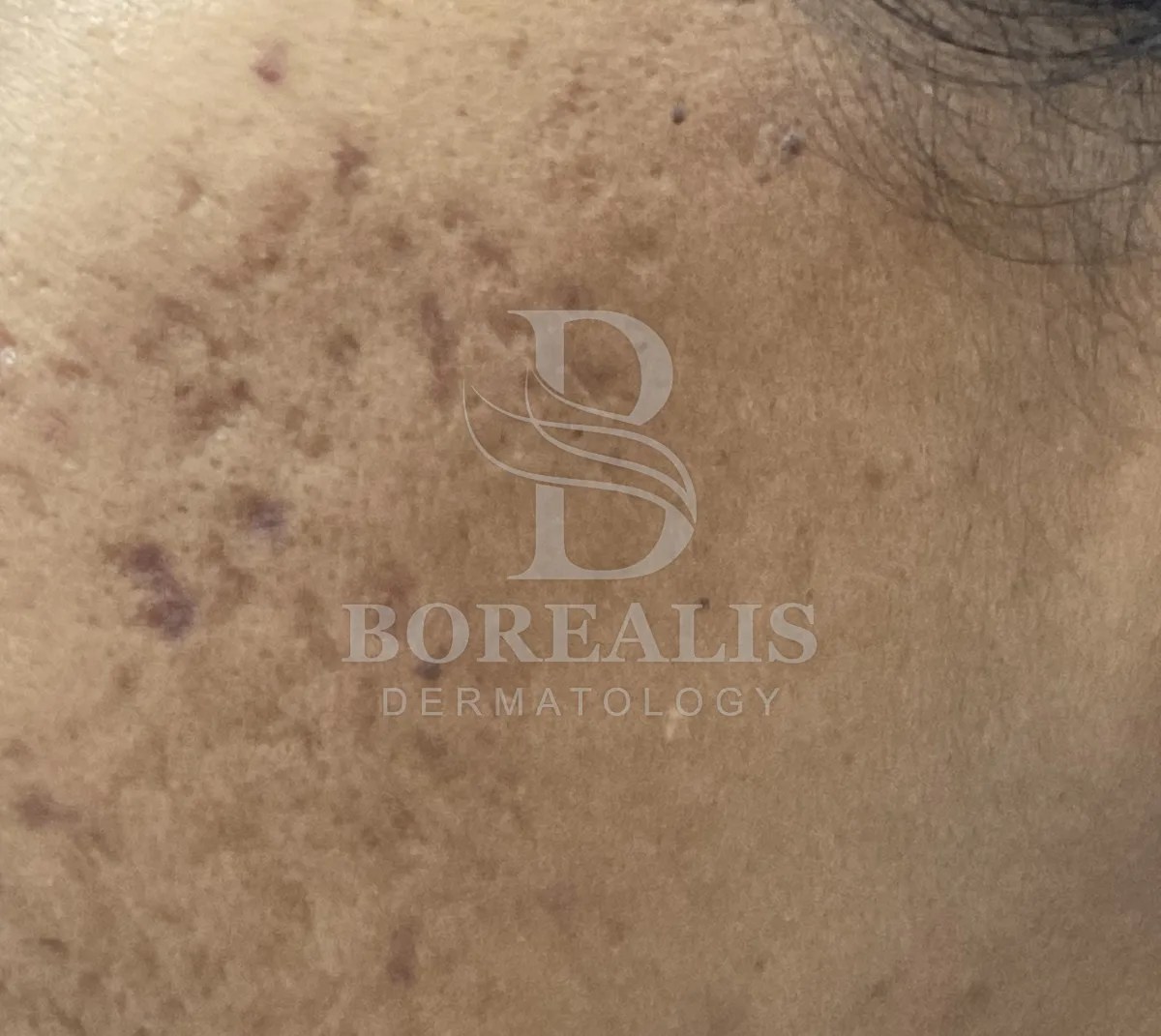 Dark spots of hyperpigmentation on the cheek