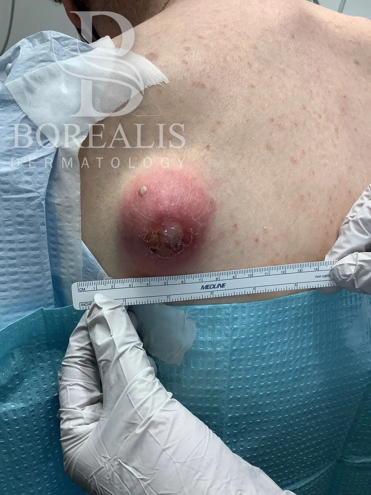 Clinical photograph of an inflamed skin abscess on the upper back