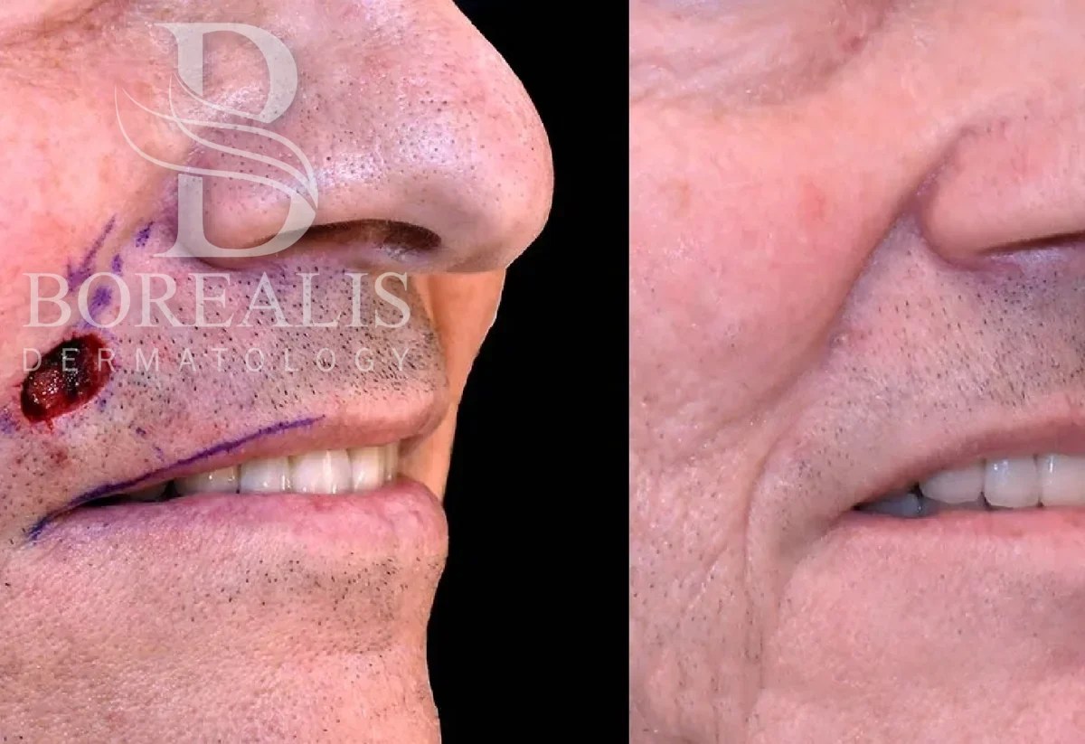 Mohs surgery wound on the face before repair