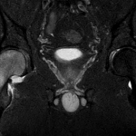 בדיקת תהודה מגנטית (MRI) של אוסטאופורוזיס חולפת של הירך