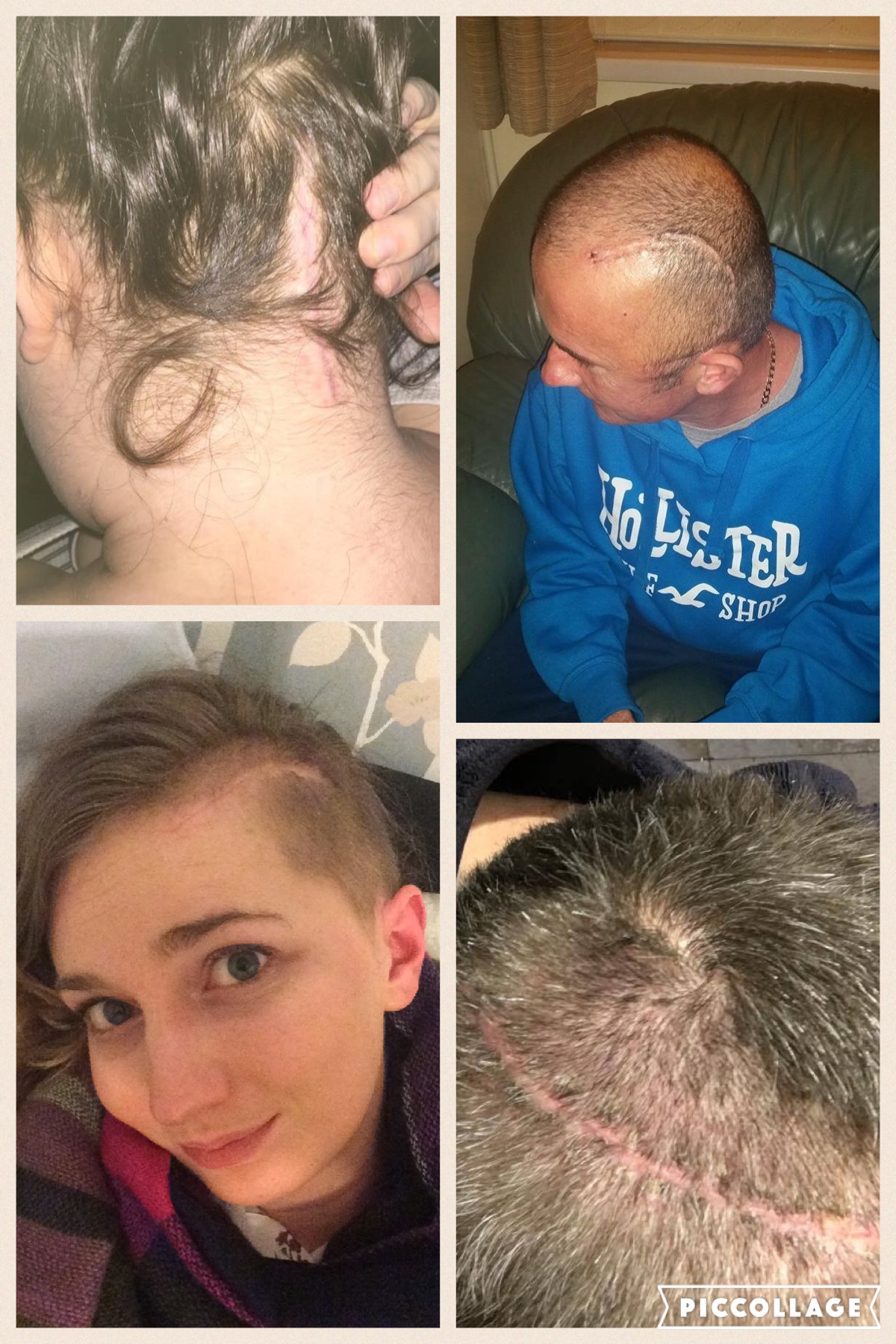 pix Staples In Head Scar surgery scars what to expect when