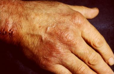 aca inflammatory phase