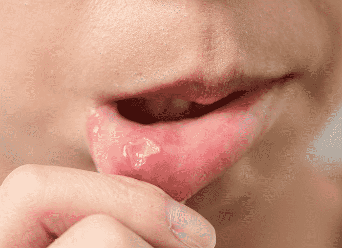 Home skin conditions & beauty centertopic guide canker sores, also known as aphthous ulcers, are common causes of painful sores in the mouth. Heal A Canker Sore Naturally Brown Thumb Mama