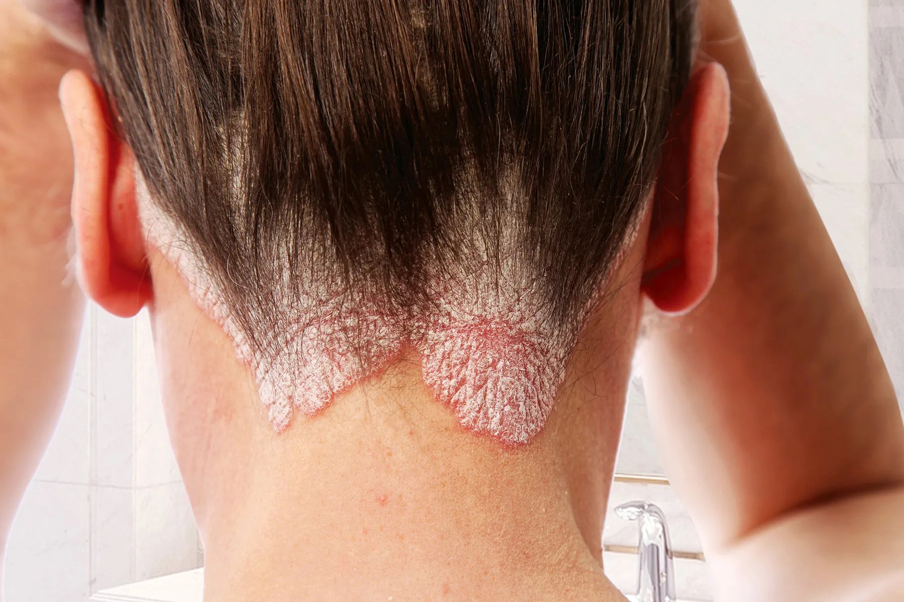 Psoriasis : pourquoi votre peau fait-elle une "Crise de nerfs" et comment la calmer ?