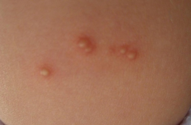 Piqure de puce, quels sont les symptômes et les solutions ...