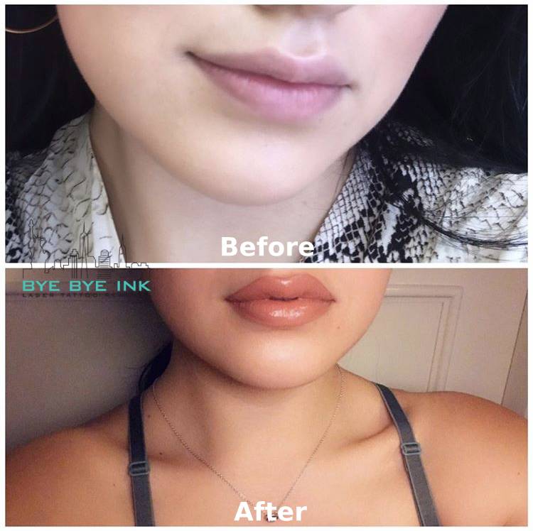 On average, the effects last from 6 weeks to 8 months. Laser Tattoo Removal Ny Bye Bye Ink Needle Free Filler