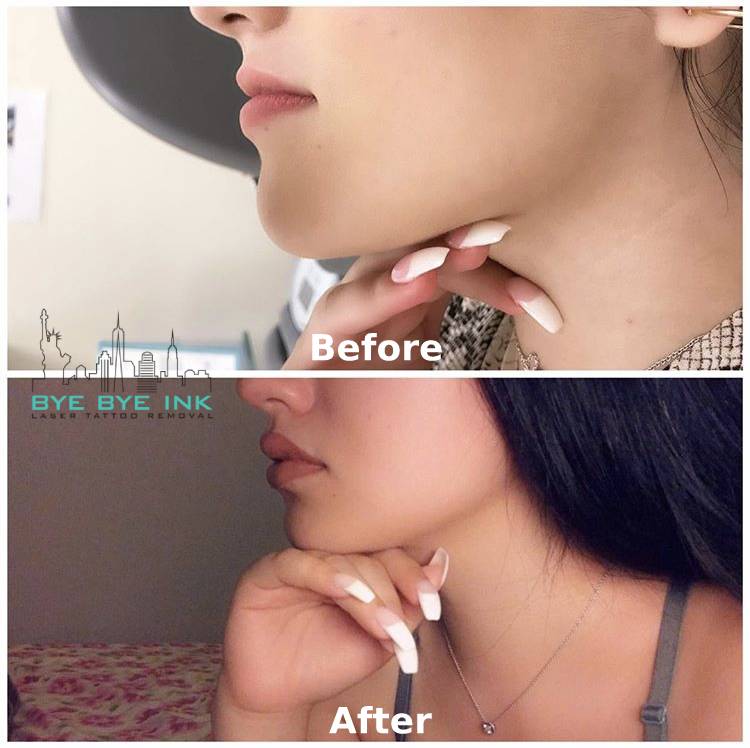 Hyaluron pen is an innovative device that uses extremely effective technology . Laser Tattoo Removal Ny Bye Bye Ink Needle Free Filler