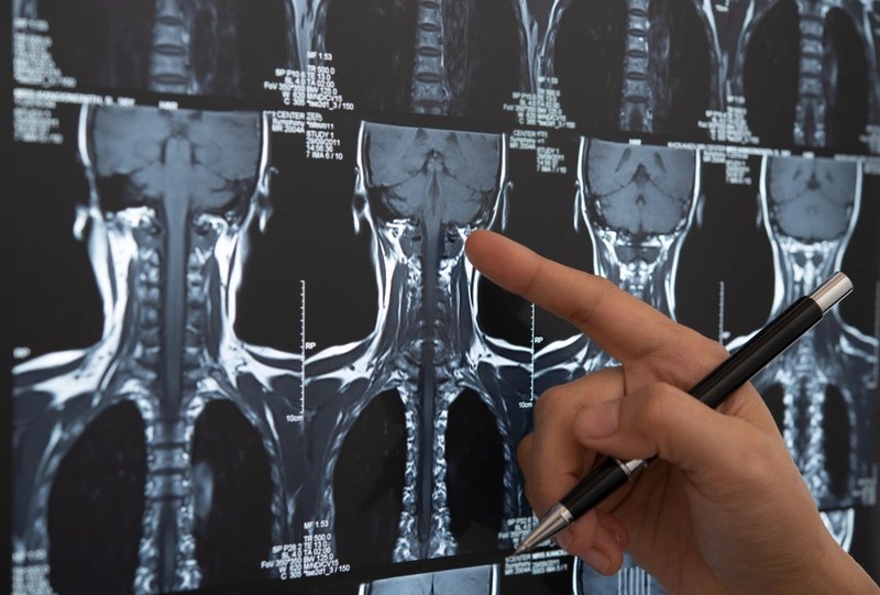Câncer de cabeça e pescoço: causas, sintomas e tratamento
