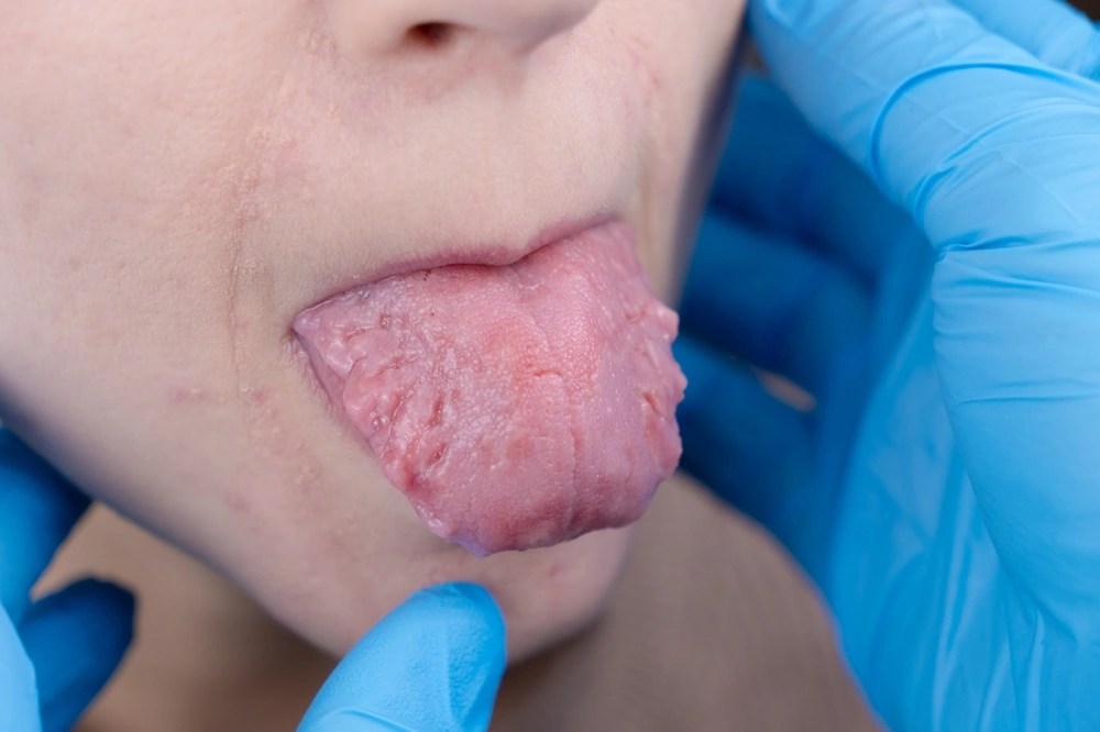 Glossectomia: como a cirurgia funciona?
