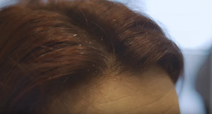 Pellicules Sèches Ou Grasses Comment Les Différencier Cachet Urbain