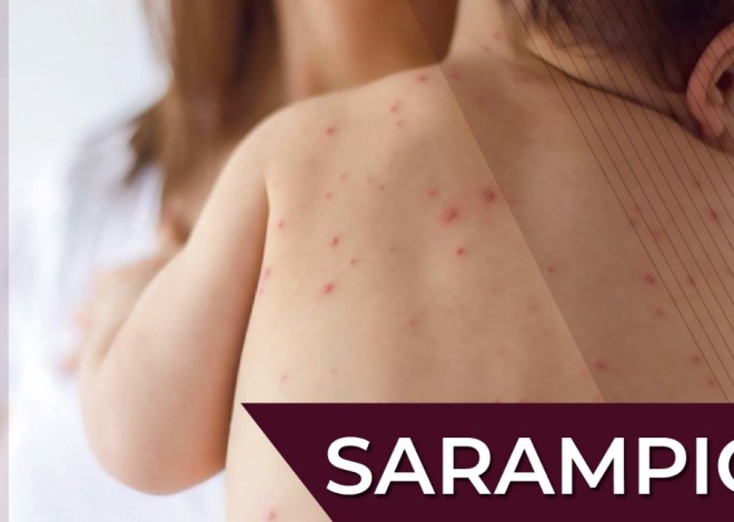Llama Coparmex-CDMX a fortalecer acciones preventivas contra el sarampión ante el reciente brote de la enfermedad