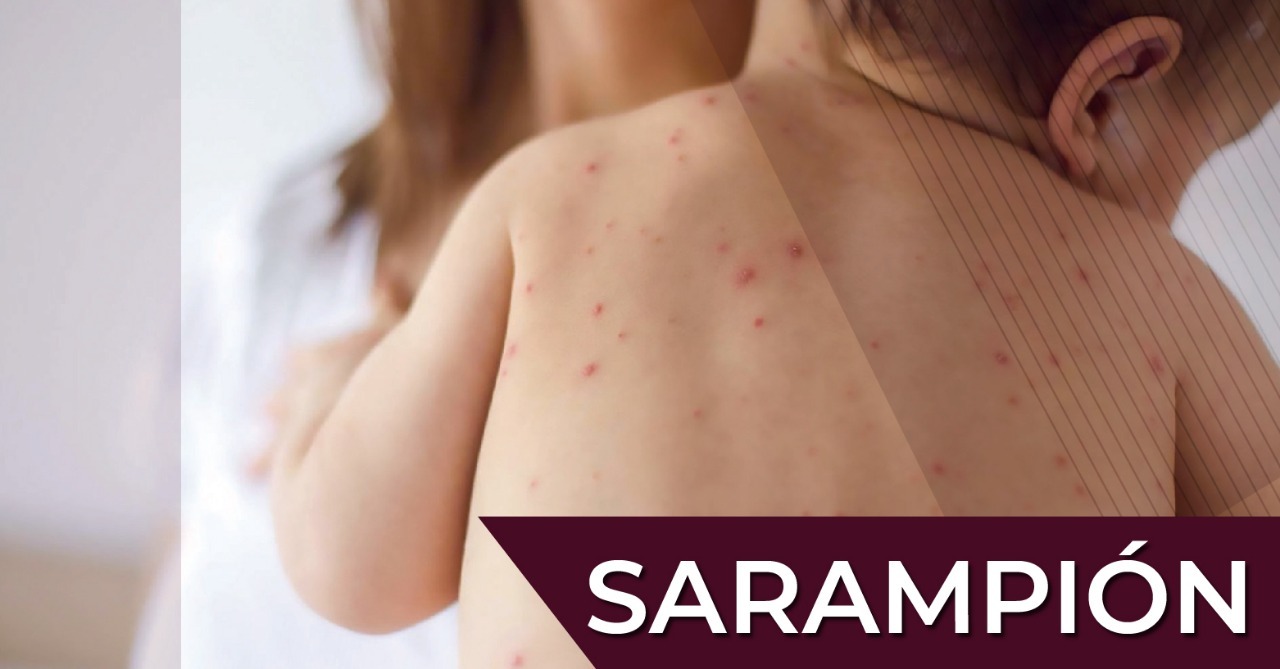 Llama Coparmex-CDMX a fortalecer acciones preventivas contra el sarampión ante el reciente brote de la enfermedad