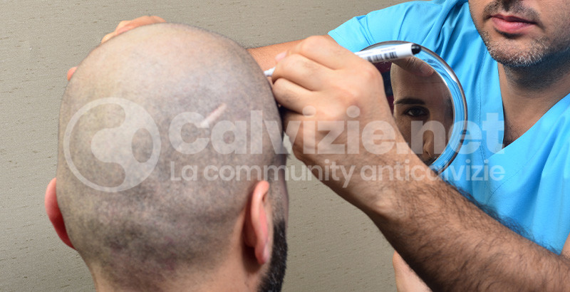 Cure Calvizie Il Futuro Prossimo Calvizie Net