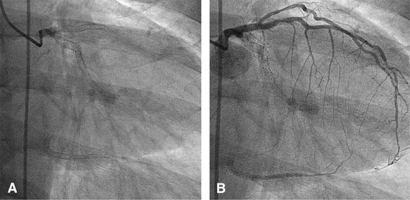 Шунтирование и стентирование что лучше. Шунтирование и стентирование сосудов сердца, в чем разница