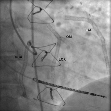 Шунтирование и стентирование что лучше. Шунтирование и стентирование сосудов сердца, в чем разница