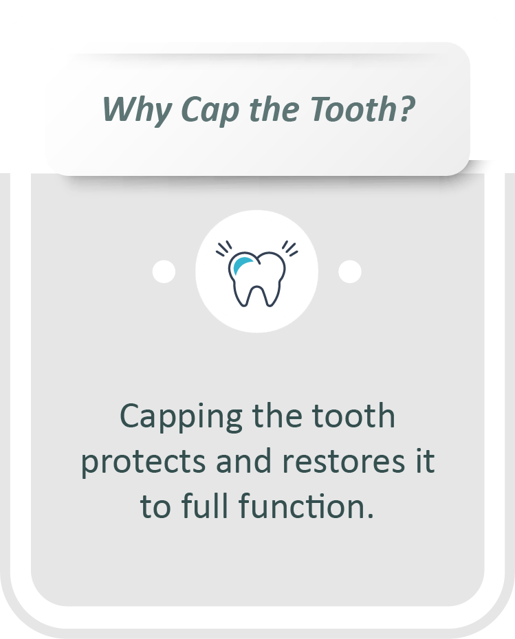 Root canal treatment infographic: Capping the tooth protects and restores it to full function.