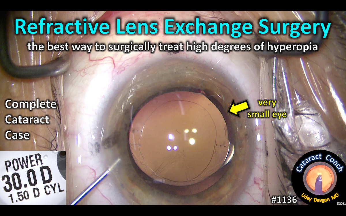 1136 Refractive Lens Exchange Surgery Cataract Coach™