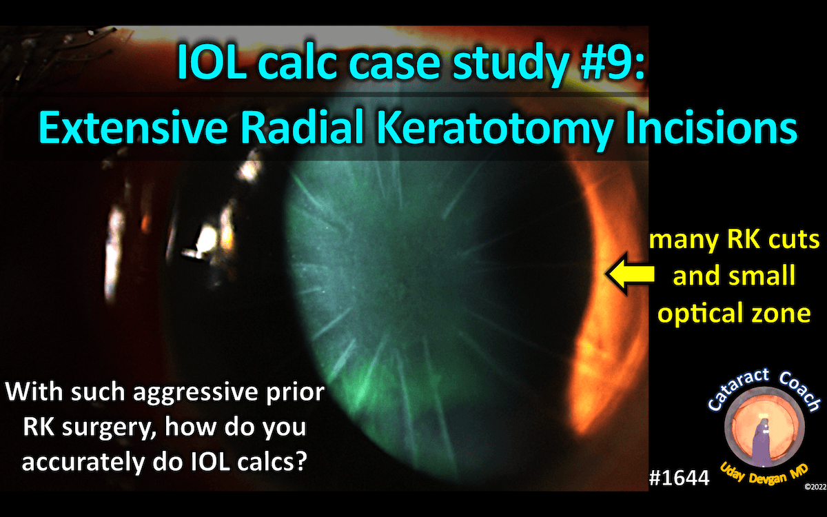 IOL calc case study – Cataract Coach™