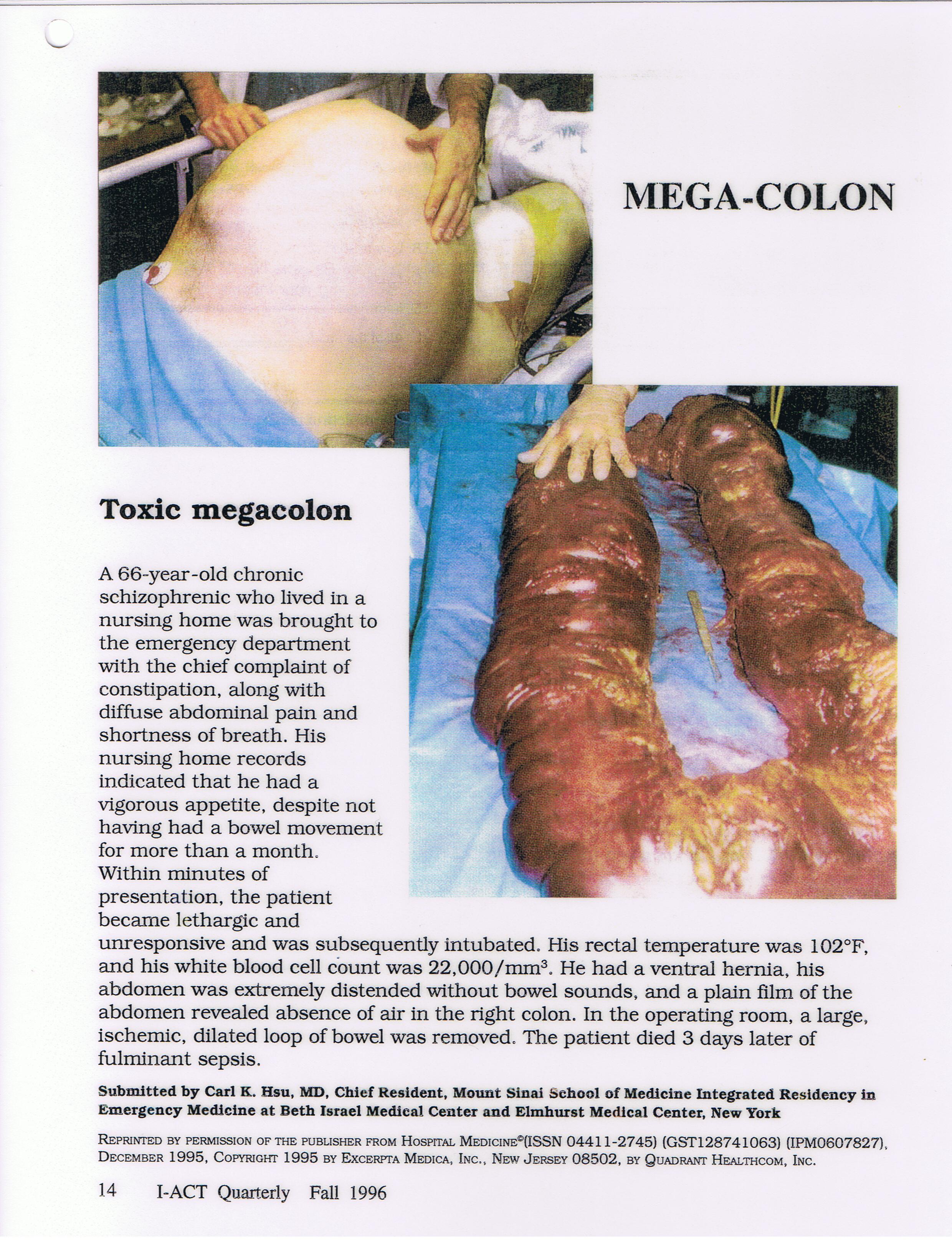 Mega Colon