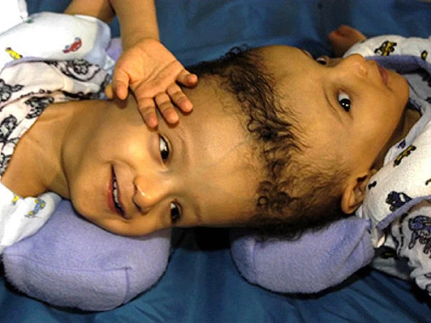 سروس کی شرائط · ہمارے بارے میں · ہم سے رابطہ کریں. Conjoined twins - Conjoined twins (WARNING: GRAPHIC IMAGES