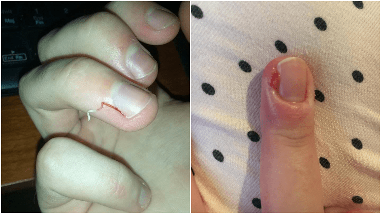 8 cara menghilangkan kapalan di telapak tangan, mudah dipraktikkan · air dan sari apel · asam salisilat dan garam epsom · nanas dan soda kue · batu . Cara Mengatasi Hangnail, Kulit Lancip yang Sering Nongol