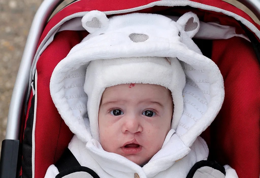 Over half of these children will need speech therapy; Cleft Lips And Palate In Babies Reasons Signs Treatment