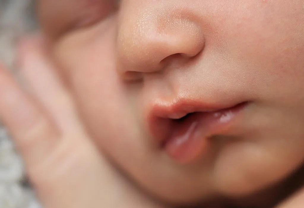 Placing fingers and other objects in the mouth would keep the upper and lower gums separated and prevent the biting of the lower lip, but will not actually . Lip Tie In Newborn Babies Reasons Symptoms Treatment