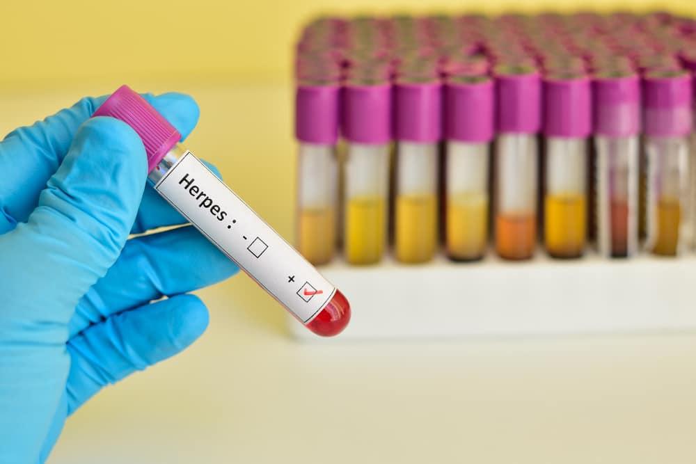 Umumnya, infeksi hsv, baik tipe 1 dan tipe 2, bersifat benigna. Penularan Herpes Simplex Lewat Apa Saja Ini Yang Harus Anda Catat